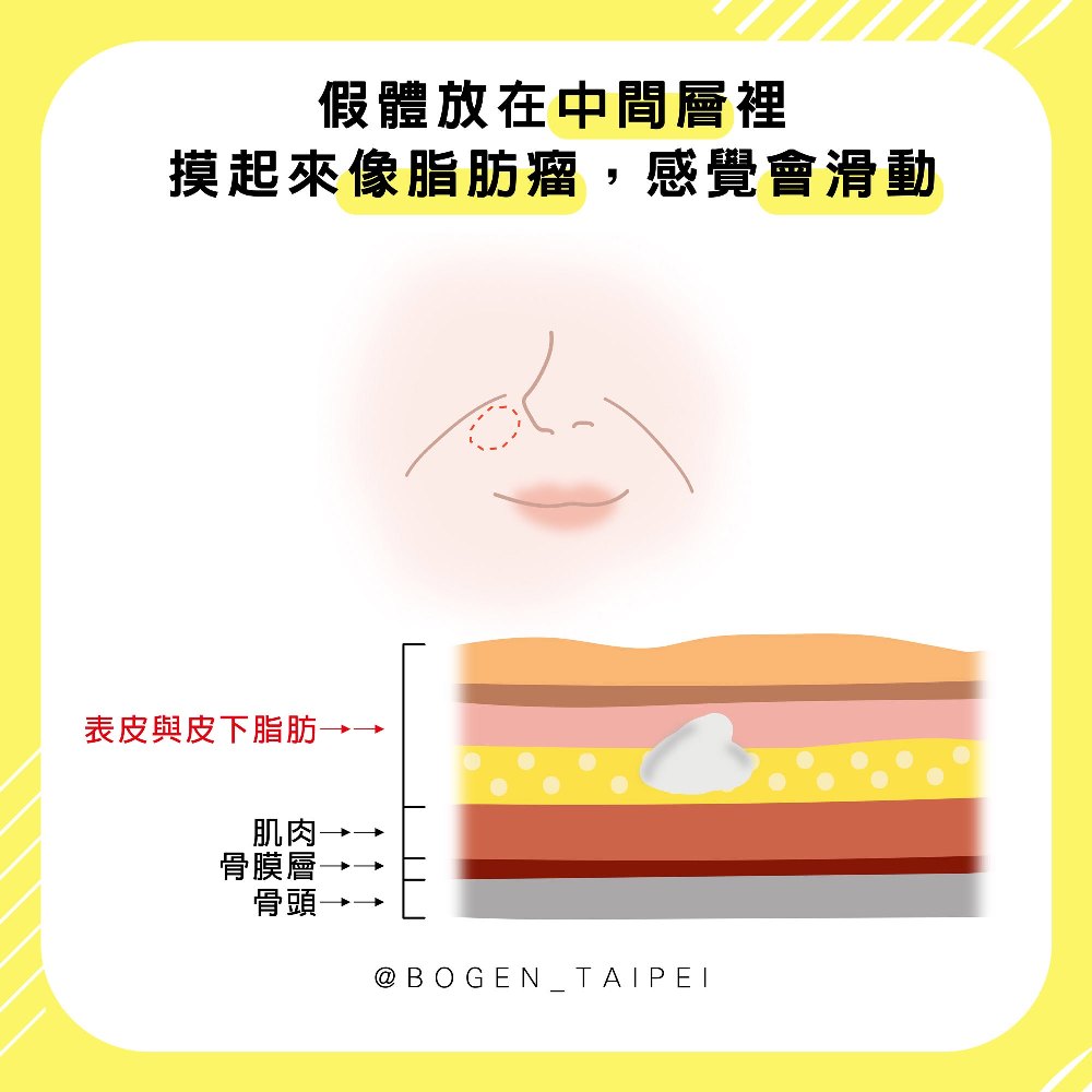 法令紋墊片植入位置,法令紋墊片觸感,法令紋墊片,博恩妍